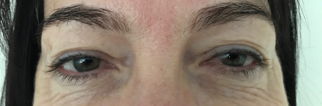 Blepharoplasty (Eyelid) Before & After Gallery 23 Patient3Before | Form & Face