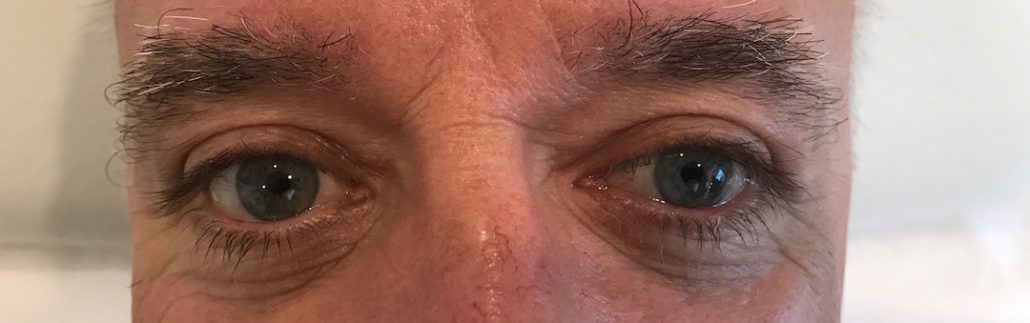 Blepharoplasty (Eyelid) Before & After Gallery 26 Patient4After | Form & Face