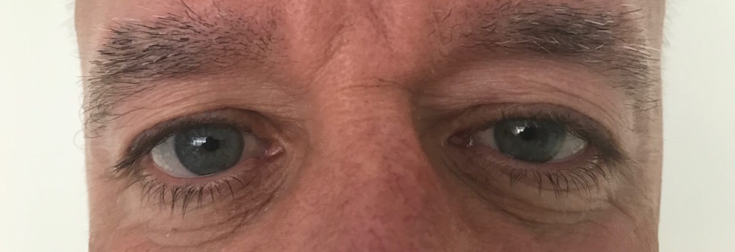 Blepharoplasty (Eyelid) Before & After Gallery 25 Patient4Before | Form & Face