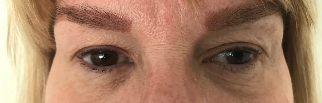 Blepharoplasty (Eyelid) Before & After Gallery 27 Patient5Before | Form & Face