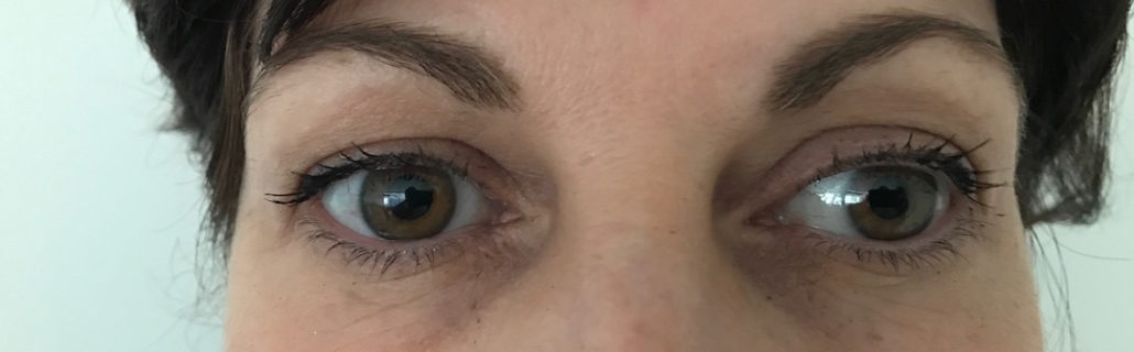 Blepharoplasty (Eyelid) Before & After Gallery 29 Patient6Before | Form & Face