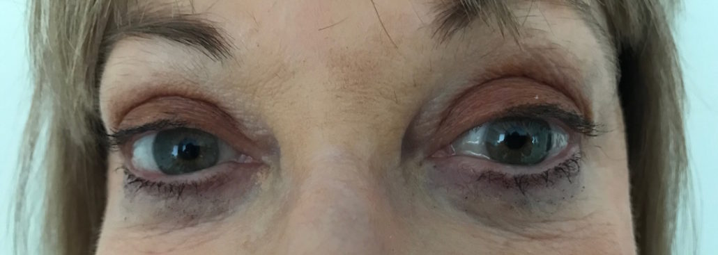 Blepharoplasty (Eyelid) Before & After Gallery 32 Patient7After | Form & Face
