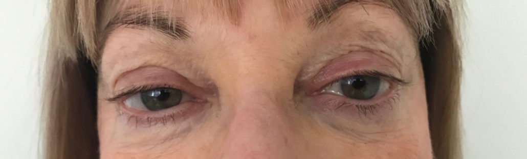 Blepharoplasty (Eyelid) Before & After Gallery 31 Patient7Before | Form & Face