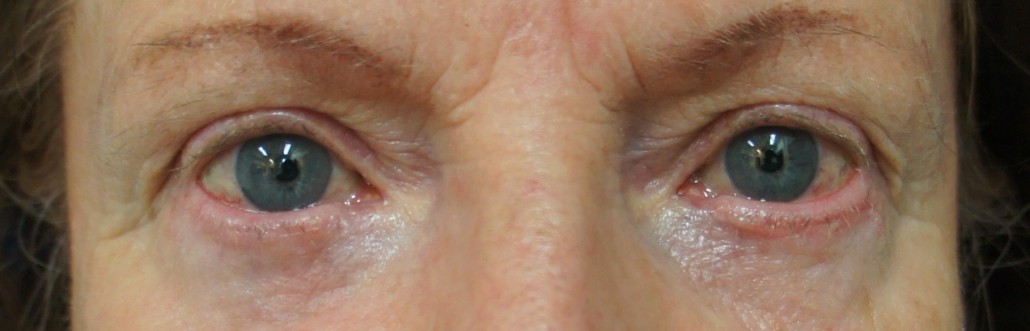 Blepharoplasty (Eyelid) Before & After Gallery 6 upper bleph post op after 2 | Form & Face