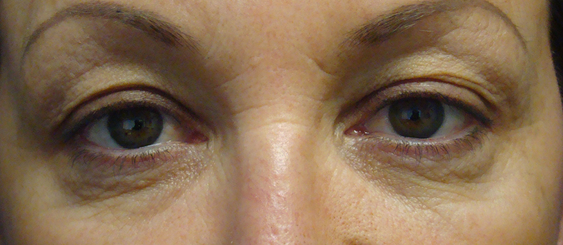 Blepharoplasty (Eyelid) Before & After Gallery 1 BlephAdermannL1009302 RETINA1 | Form & Face