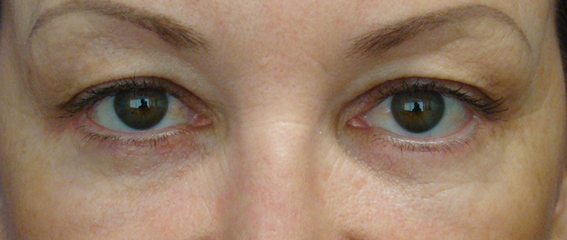 Blepharoplasty (Eyelid) Before & After Gallery 2 BlephLowerAdermannL1011182 RETINA1 | Form & Face