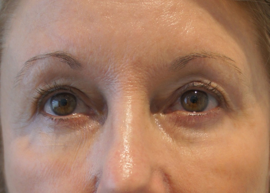 Blepharoplasty (Eyelid) Before & After Gallery 13 BlephPatient2 2 | Form & Face