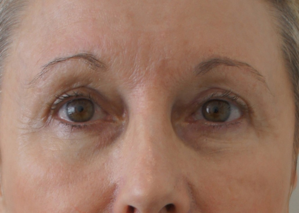 Blepharoplasty (Eyelid) Before & After Gallery 14 BlephPatient2 3 | Form & Face