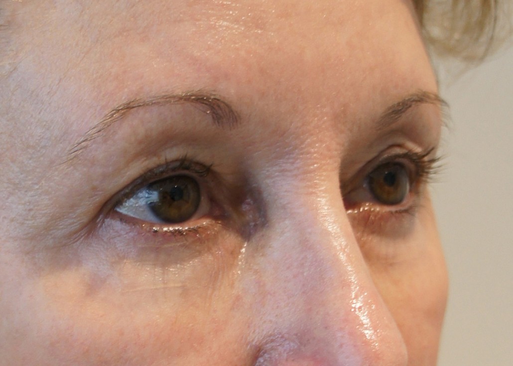 Blepharoplasty (Eyelid) Before & After Gallery 15 BlephPatient2 4 | Form & Face