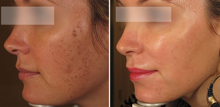 Laser Skin Rejuvenation 7 001 BBL ba | Form & Face