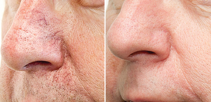 Laser Skin Rejuvenation 8 002 BBL Redness | Form & Face