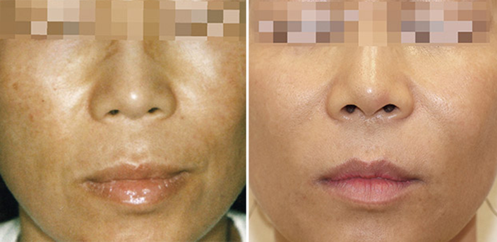 Laser Skin Rejuvenation 6 002 BBL young | Form & Face