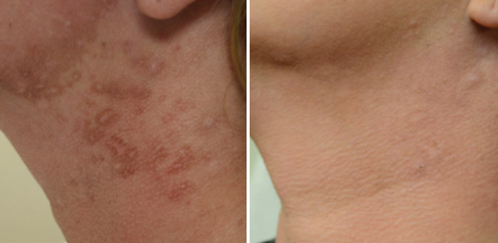 Laser Skin Rejuvenation 4 halo ba | Form & Face
