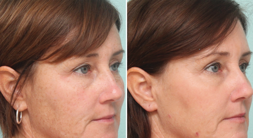 Laser Skin Rejuvenation 5 micropeel 4 | Form & Face