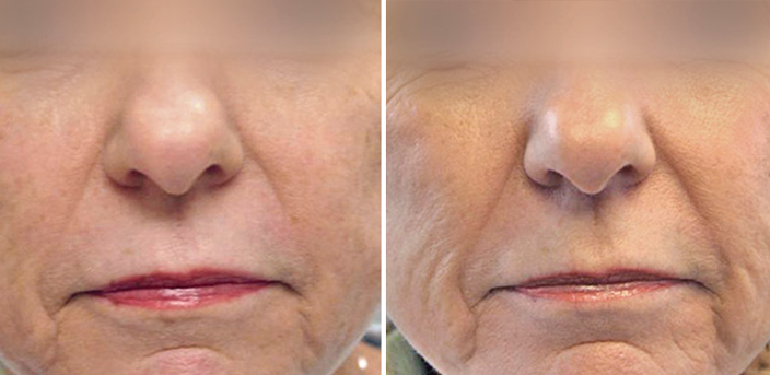 Laser Skin Rejuvenation 3 pro fractiona ba | Form & Face