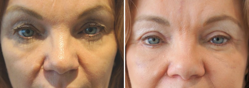Facial fat transfer & eyelid surgery 06, upper and lower blepharoplasty